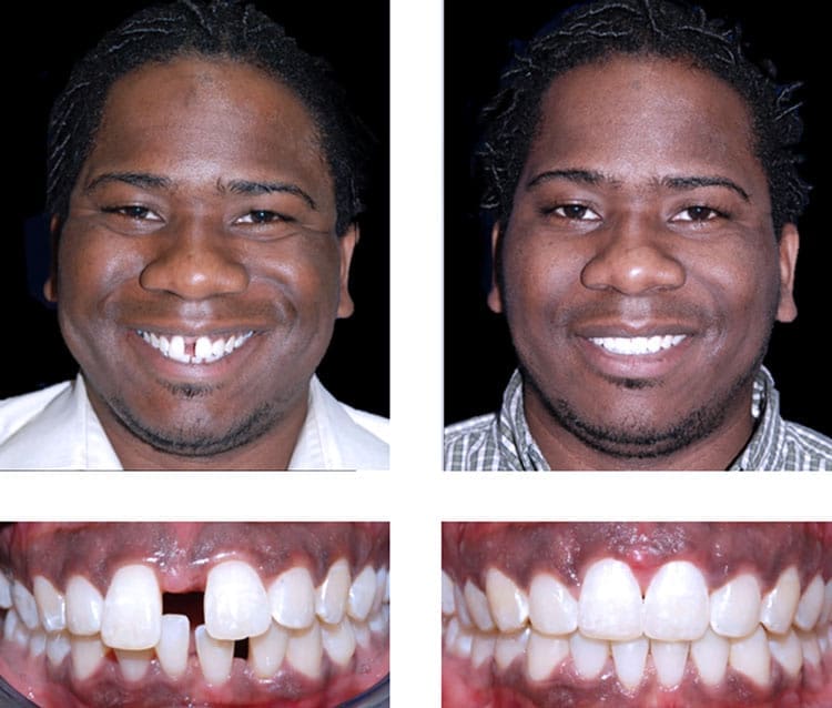 Adult Braces Patient - Align Orthodontics