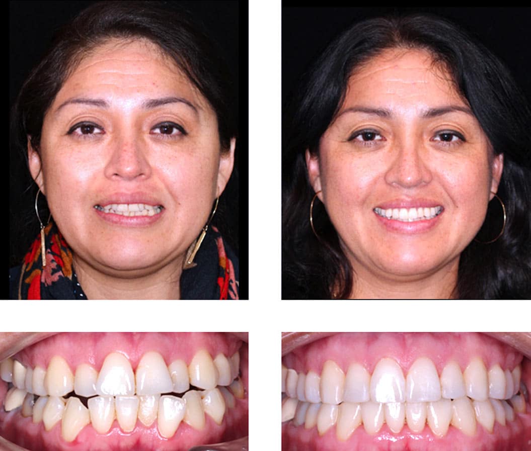Adult Invisalign Patient