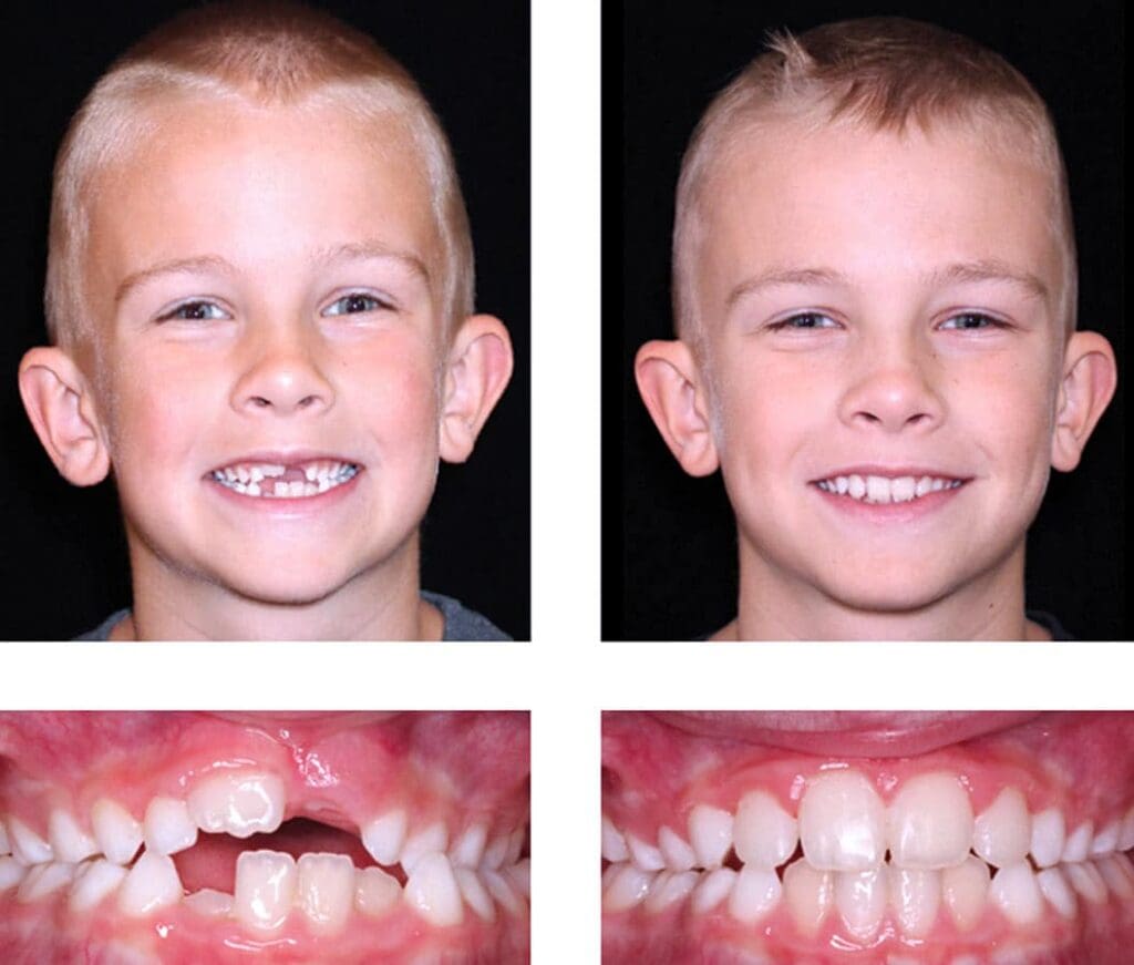 Adult Orthodontics - Before and After