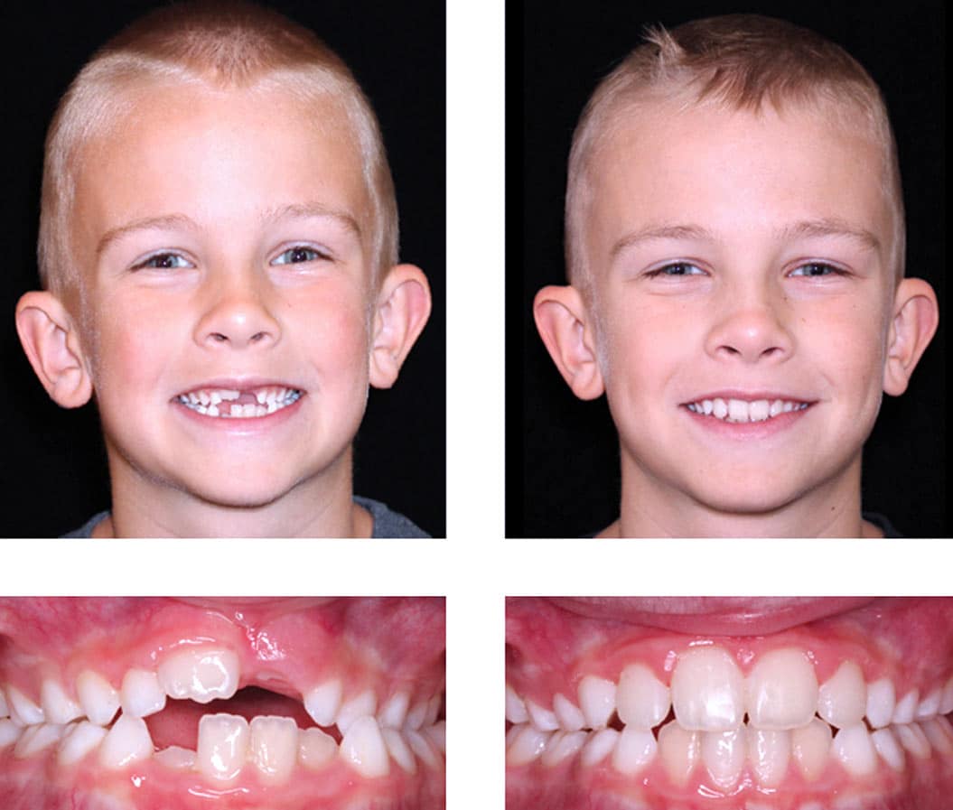 Child Orthodontics