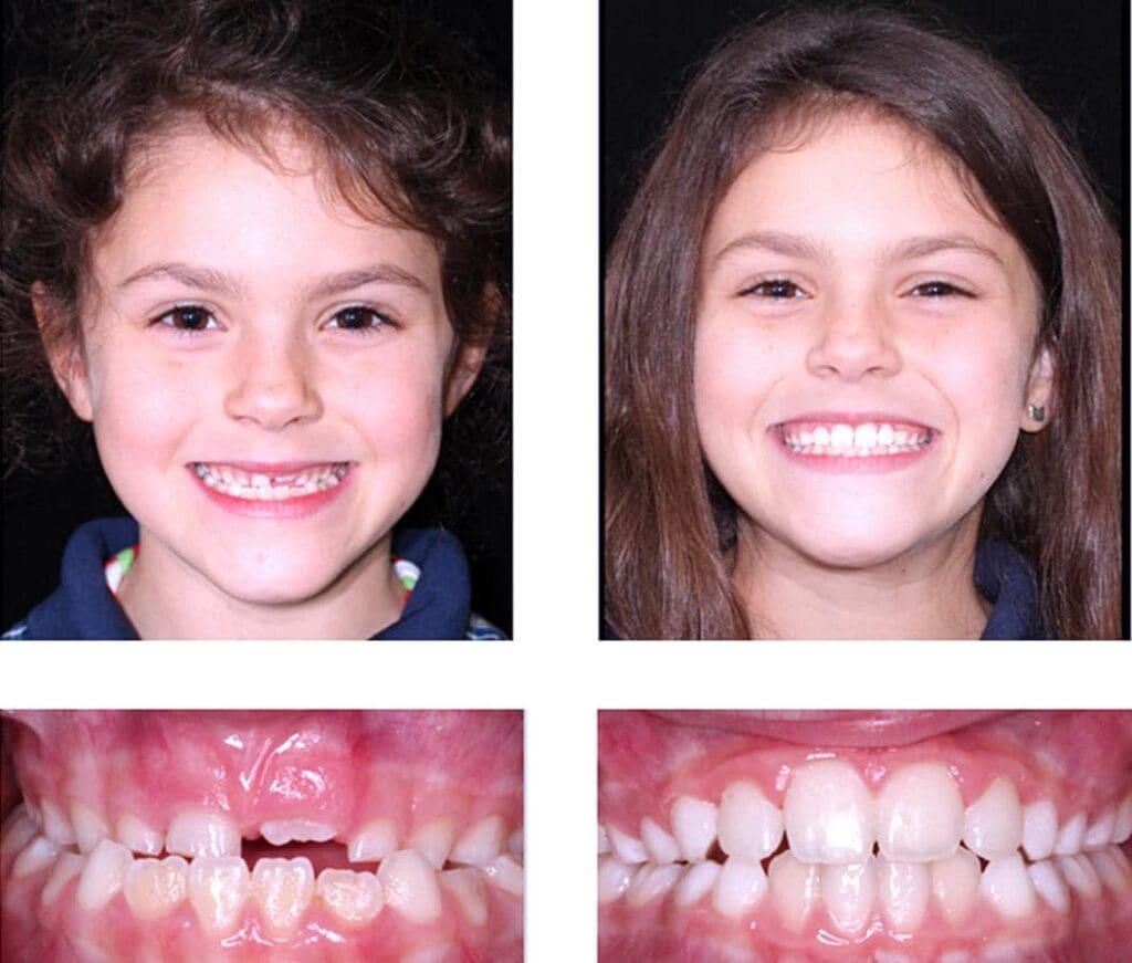 Adult Orthodontics - Before and After