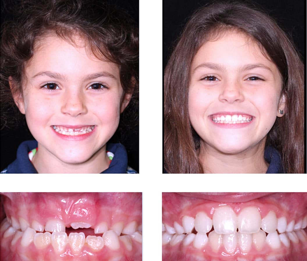 Phase 1 Orthodontics
