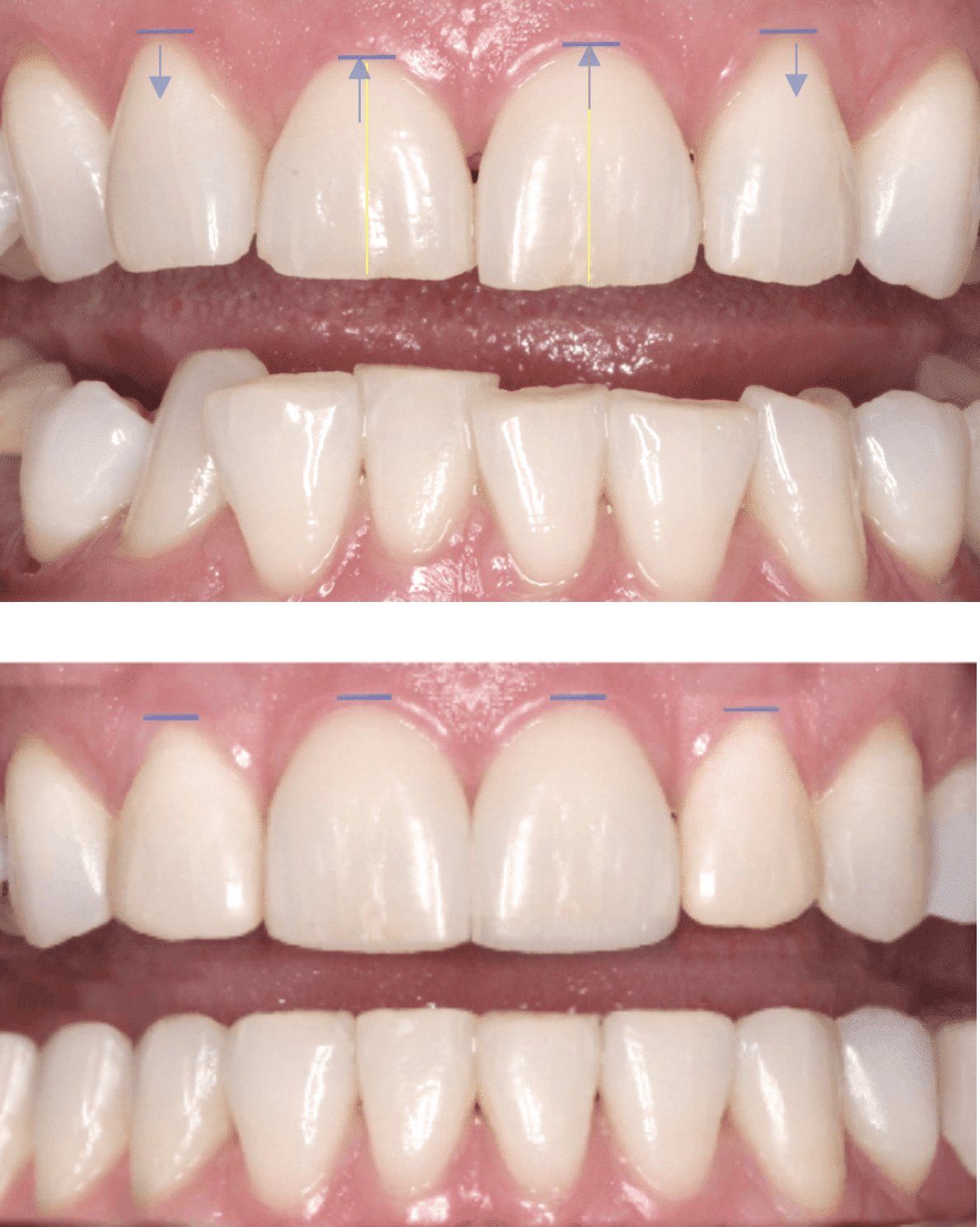 Rebuilding and reshaping teeth before orthodontic treatment