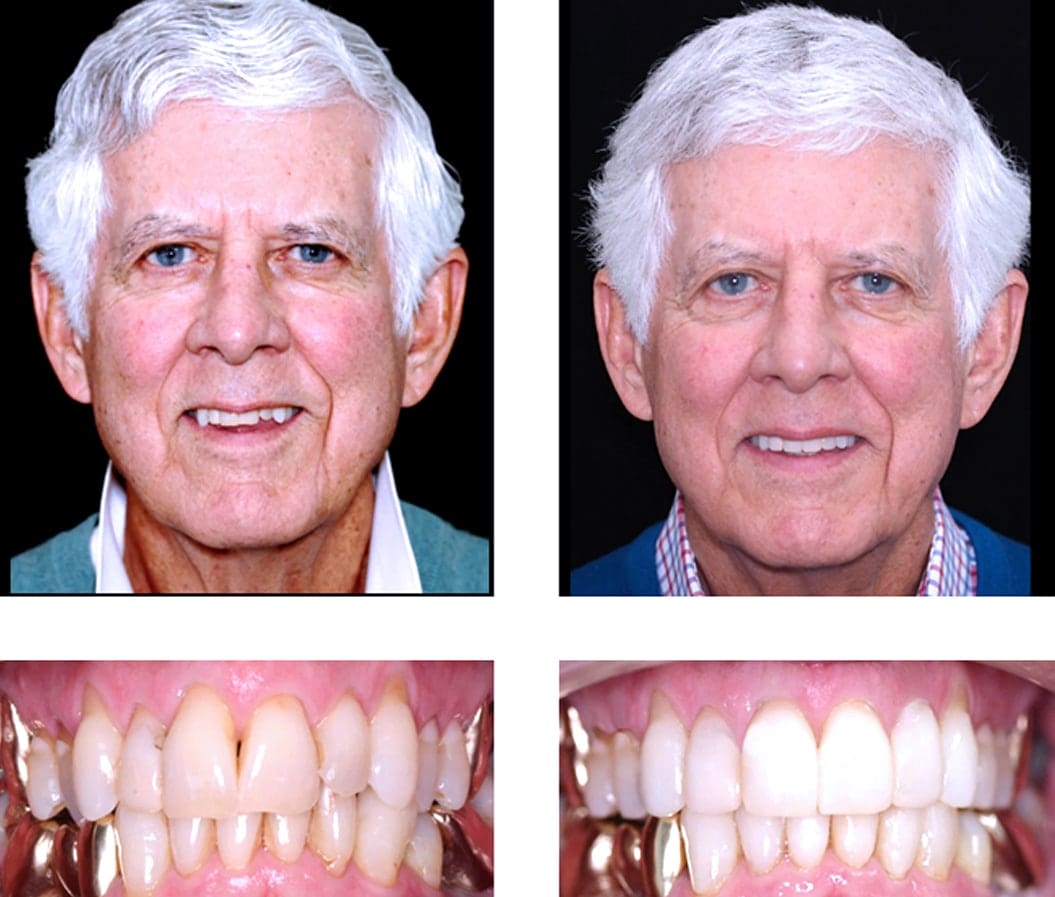 Adult Orthodontics - Before and After
