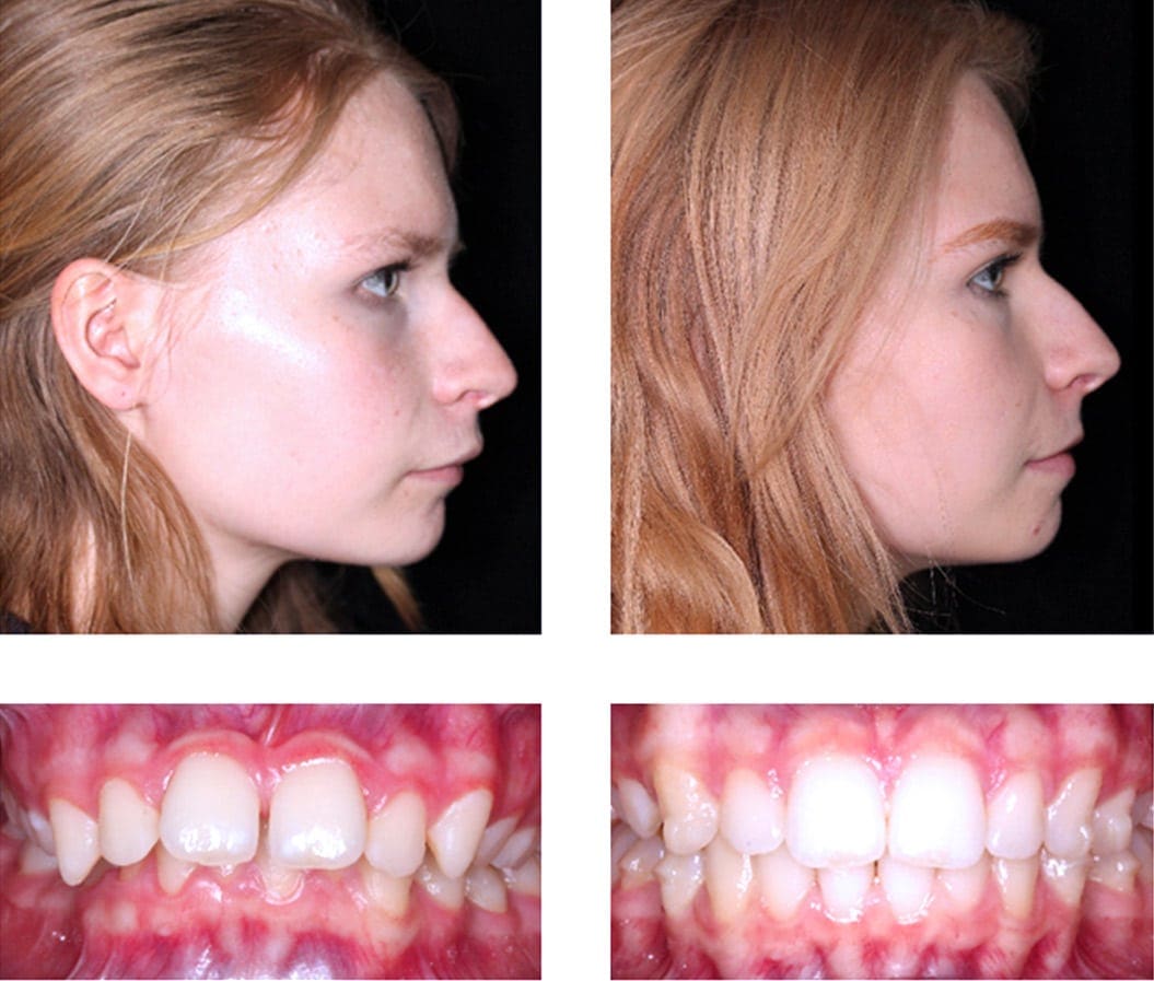 Teen Invisalign