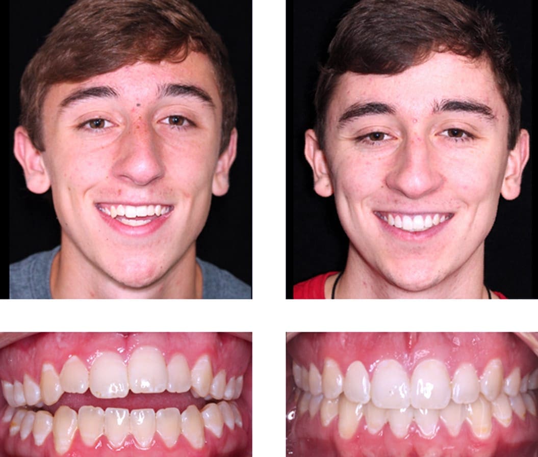 Teens treated with Invisalign