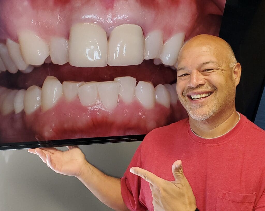 Before and after orthodontic treatment - Align Orthodontics