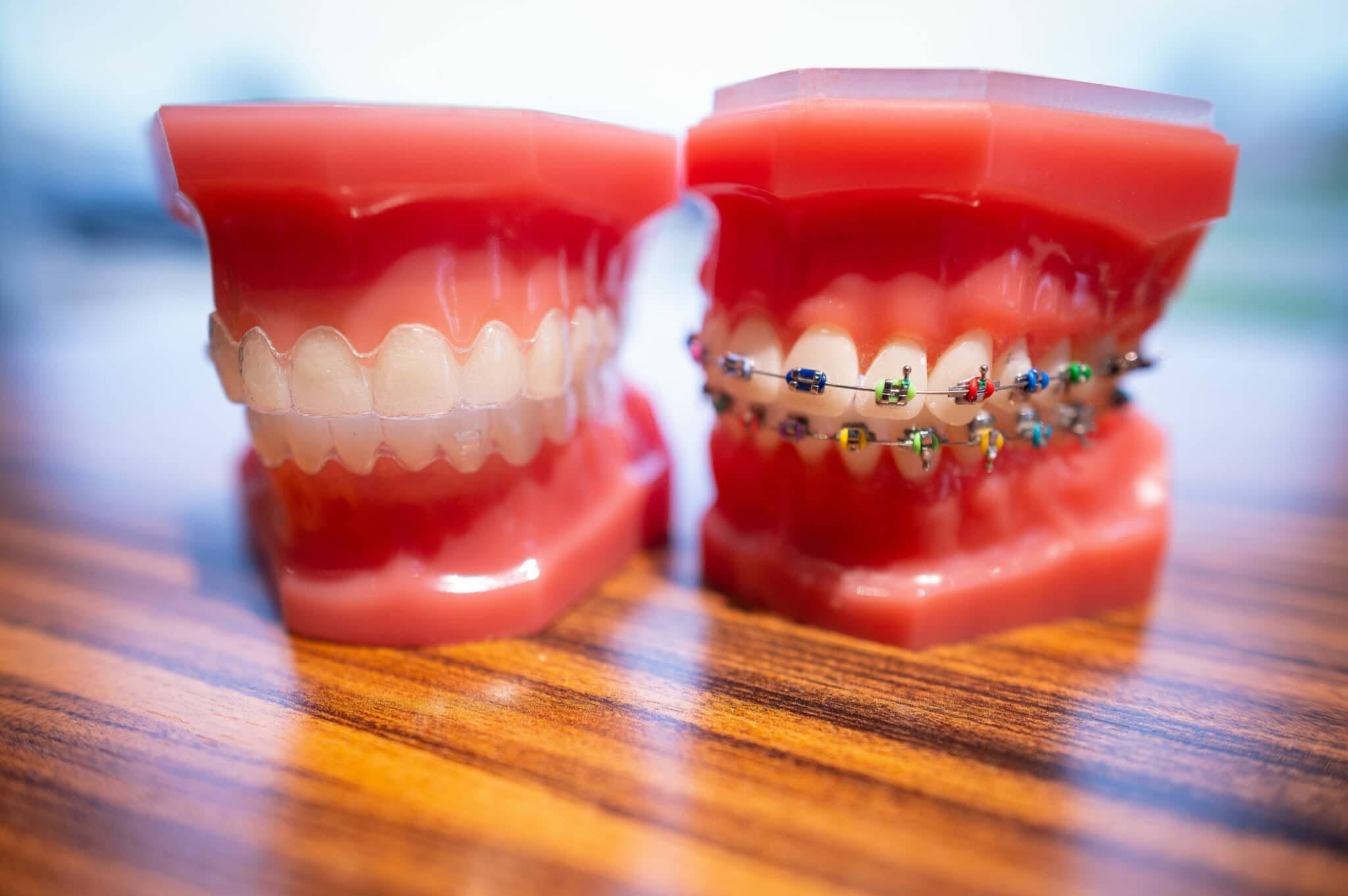 Braces vs. Clear Aligners: Which Is Best for Me?
