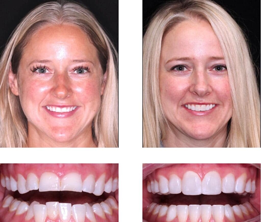 Before and after orthodontic treatment - Align Orthodontics