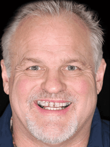 David's Story - Facial and Dental Trauma