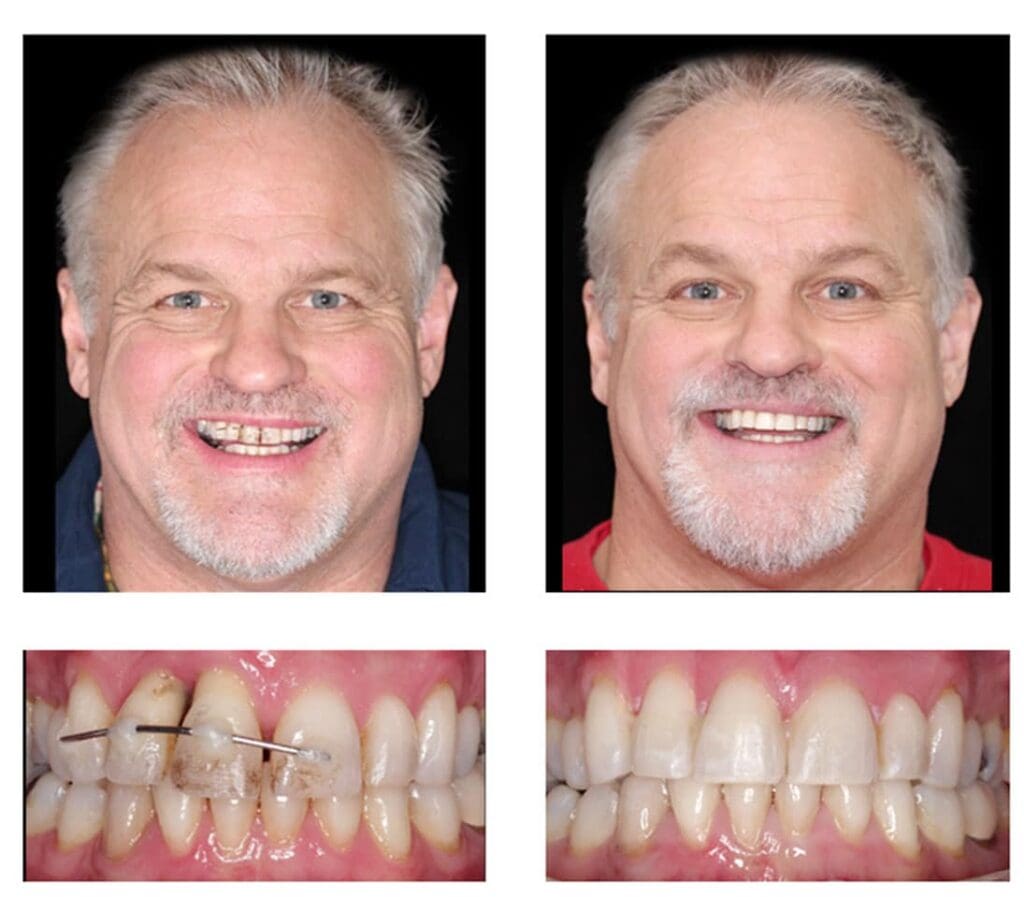 Before and after orthodontic treatment - Align Orthodontics
