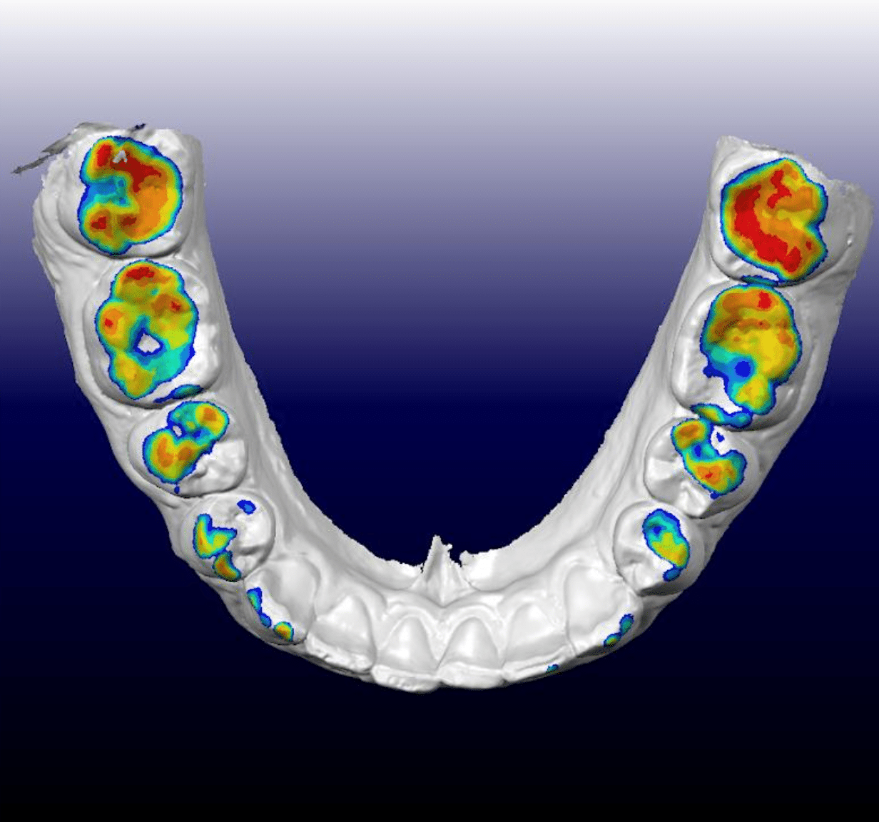 The Difference Between a Cross Bite and an Overbite