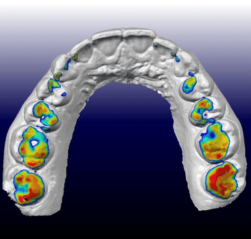 Intraoral Scanner - Align Orthodontics