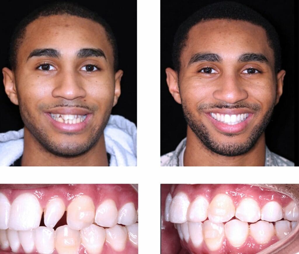 Before and After Orthodontic Treatment - Align Orthodontics