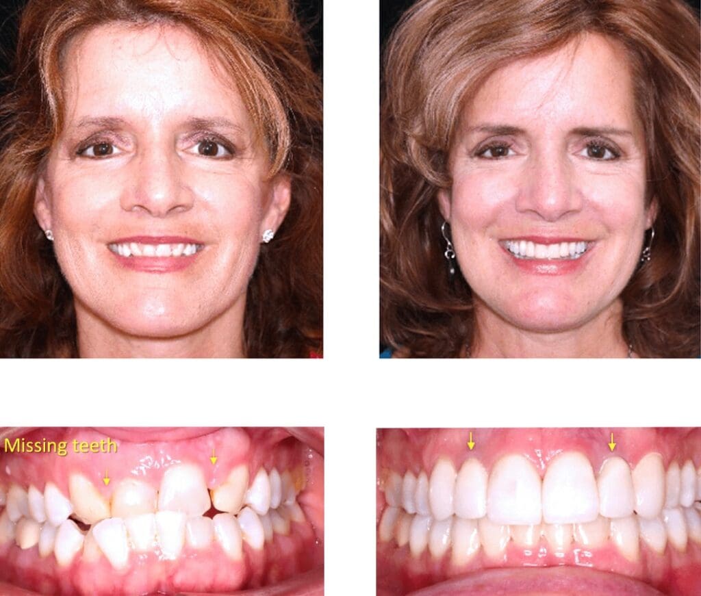 Before and After Orthodontic Treatment - Align Orthodontics