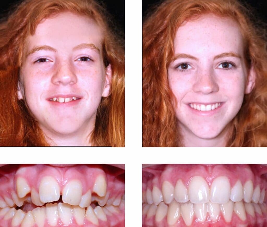 Before and After Orthodontic Treatment - Align Orthodontics