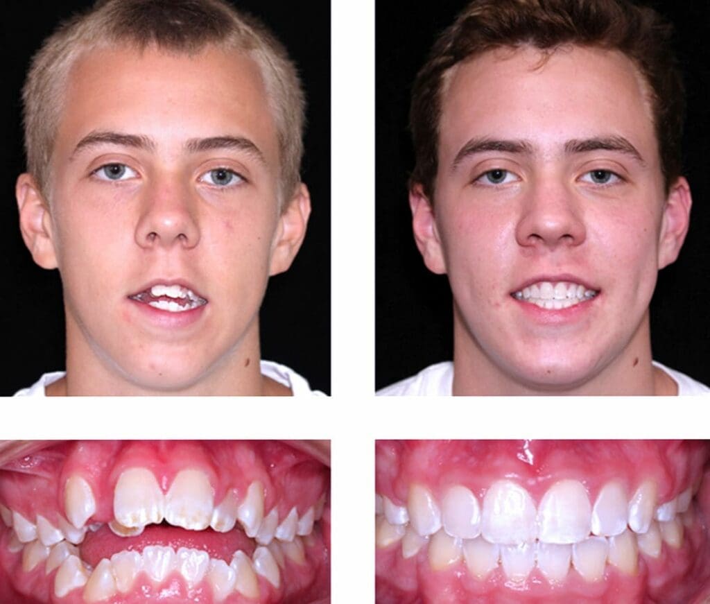 Before and After Orthodontic Treatment - Align Orthodontics