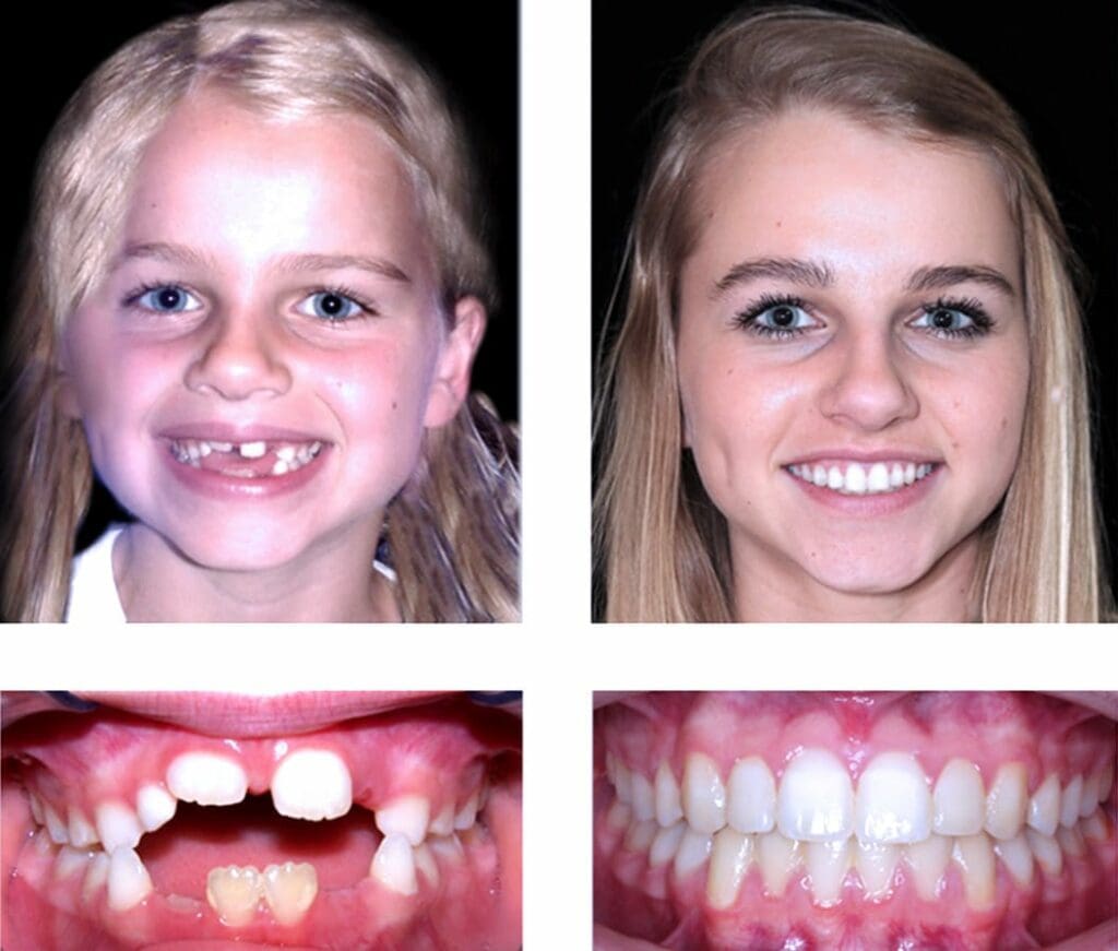 Before and After Orthodontic Treatment - Align Orthodontics