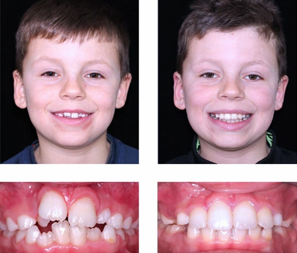 Before and After Orthodontic Treatment - Align Orthodontics
