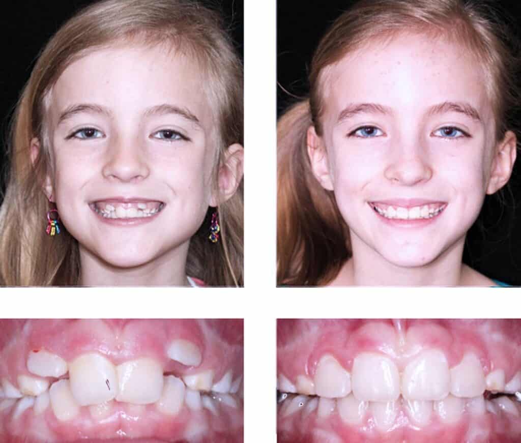 Before and after orthodontic treatment - Align Orthodontics
